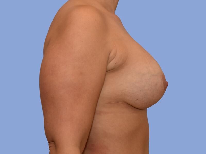 Breast lift before & after photo